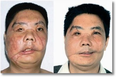 face-transplant